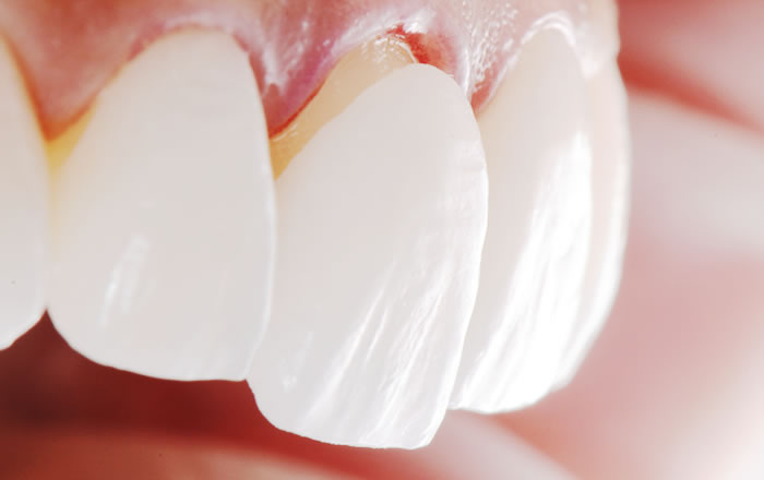ポーセレンラミネートべニアは歯が噛み合う箇所には使えない
