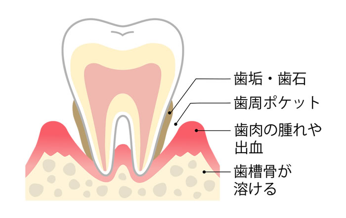 味覚障害の治療で歯科治療が有効な場合：歯周病治療