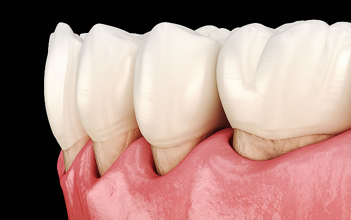歯周病による歯の揺れ、グラつき