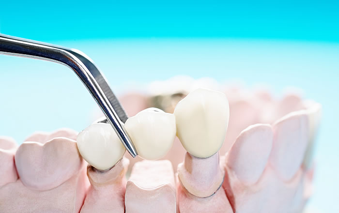 歯周病による歯の揺れ、歯のグラつきの治療：補綴治療による歯の固定