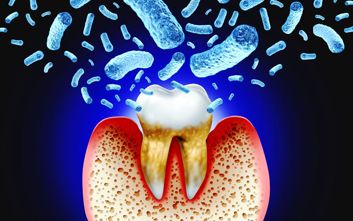 歯槽膿漏（しそうのうろう）って何？