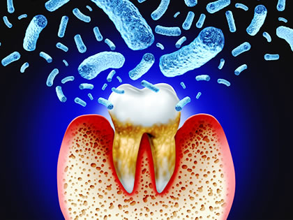 歯槽膿漏（しそうのうろう）って何？