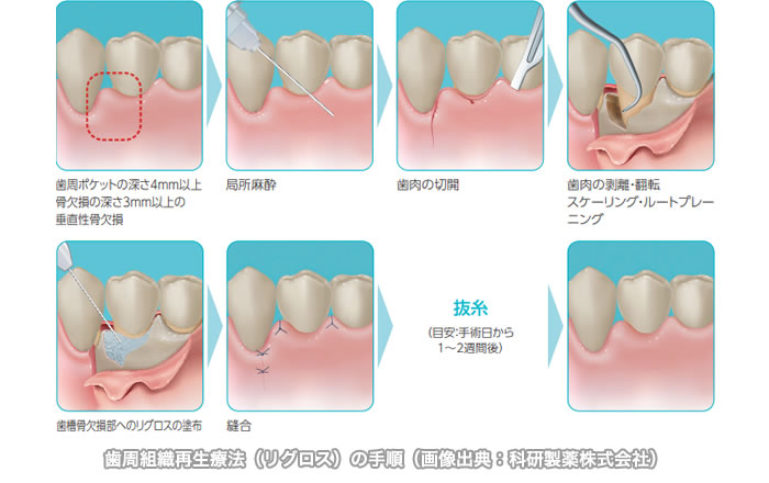 歯周組織再生療法の手順（リグロスの例）