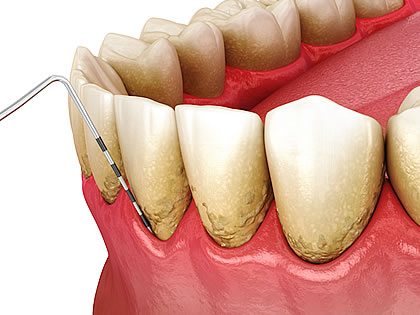 歯周組織再生療法とは？