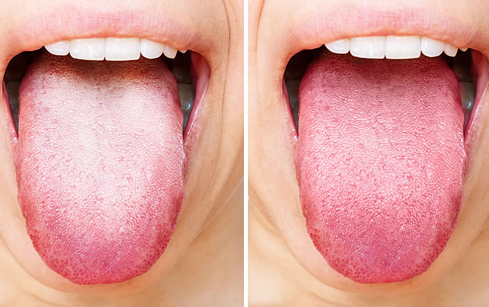 味覚障害の治療で歯科治療が有効な場合：舌苔への対処