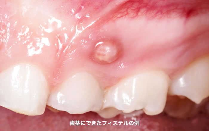 歯茎が腫れたり痛んだりする原因：フィステルなど