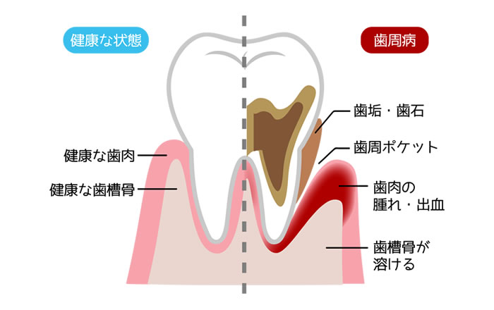 歯茎が腫れたり痛んだりする原因：歯周病