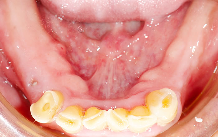 歯茎が腫れたり痛んだりする原因：骨隆起