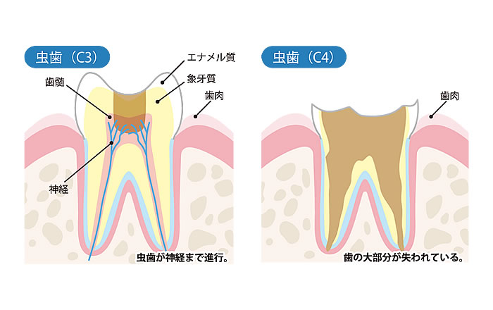 カリソルブ治療は治療できる虫歯が限られる