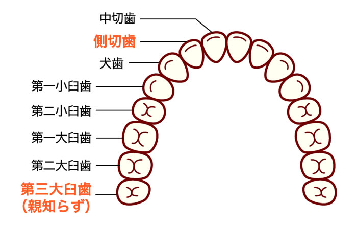 矮小歯になりやすい歯は、上あごの前から2番目の歯（側切歯：そくせっし）や親知らず