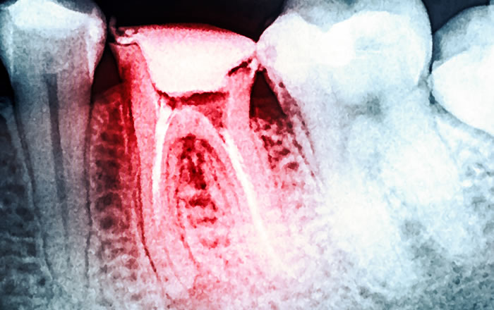 虫歯で顎が痛くなる理由：骨の炎症が生じているから