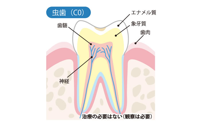 虫歯の進行度 CO：初期虫歯・白濁