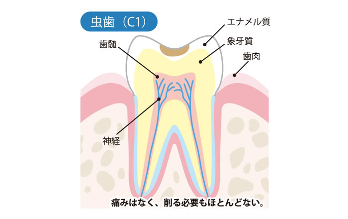 虫歯の進行度 C1：エナメル質が溶けた状態