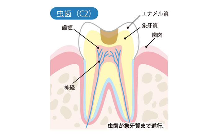 虫歯の進行度 C2：象牙質にまで虫歯が進行した状態