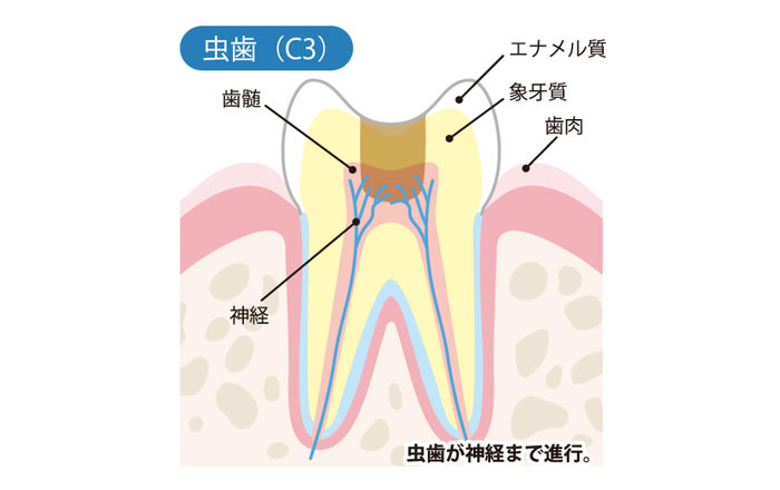 虫歯の進行度 C3：神経にまで虫歯が進行した状態