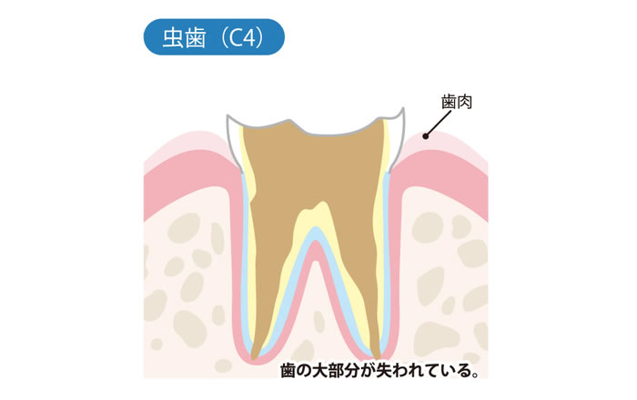 虫歯の進行度 C4：歯根まで虫歯が進行した状態