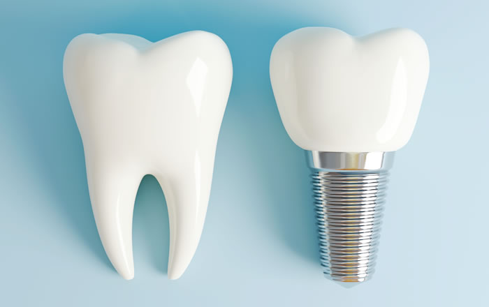 インプラントと歯の移植の違い