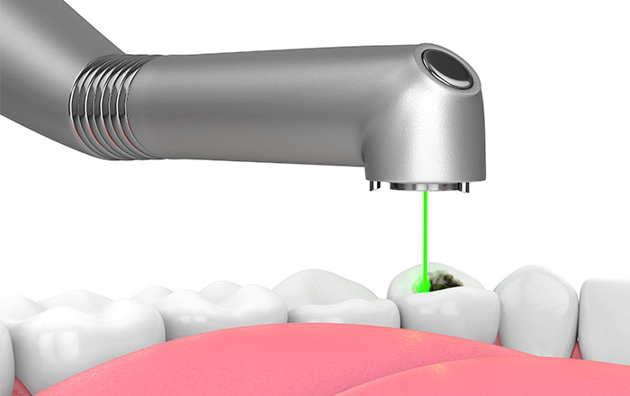 レーザーによる虫歯治療